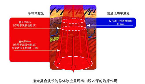 半導(dǎo)體激光組織穿透示意圖